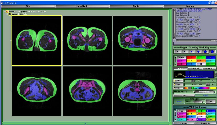 Tomovision sliceOmatic(医学图像分析软件) v5.0 Rev-9免费版